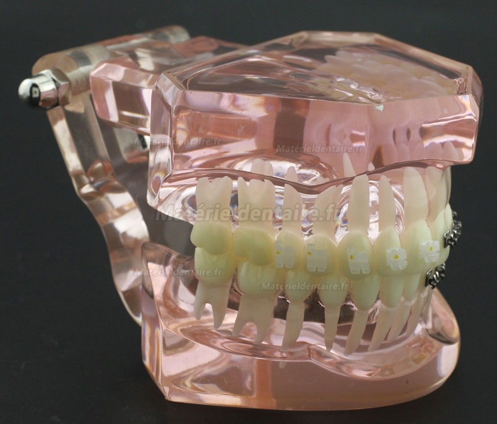 Modèle Orthodontie Contraste des brackets M3009