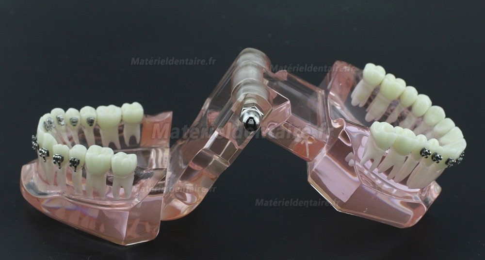 Modèle Orthodontie Contraste des brackets M3009