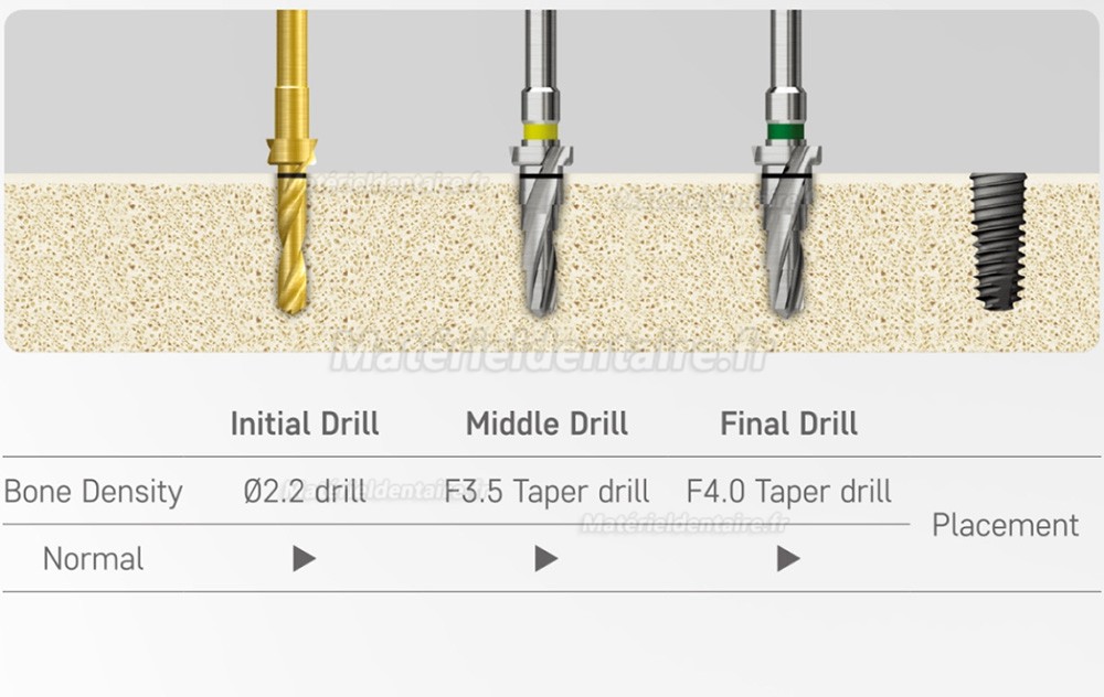 Kit chirurgical cône Osstem Hiossen avec clé dynamométrique (à utiliser pour TSⅢ/Ⅳ SSⅢ USⅢ/Ⅳ)