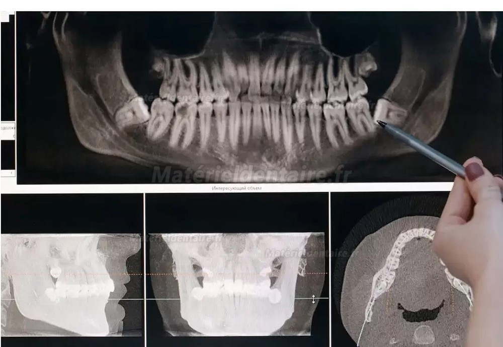 Refine MaxSurgery Appareil piézochirurgie dentaire /appareil chirurgie ultrasonique