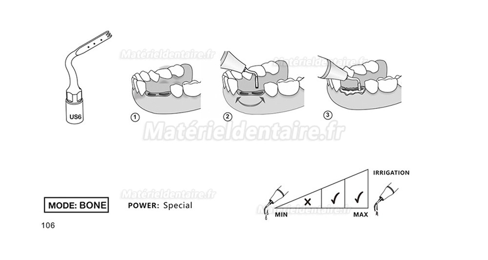 1 Pièces Inserts piezosurgery pour la chirurgie osseuse US1 US1L US1R US2 US3 US4 US5 US6 US7 US11 US12 compatible avec Mectron Silfradent Dmetec Woodpecker