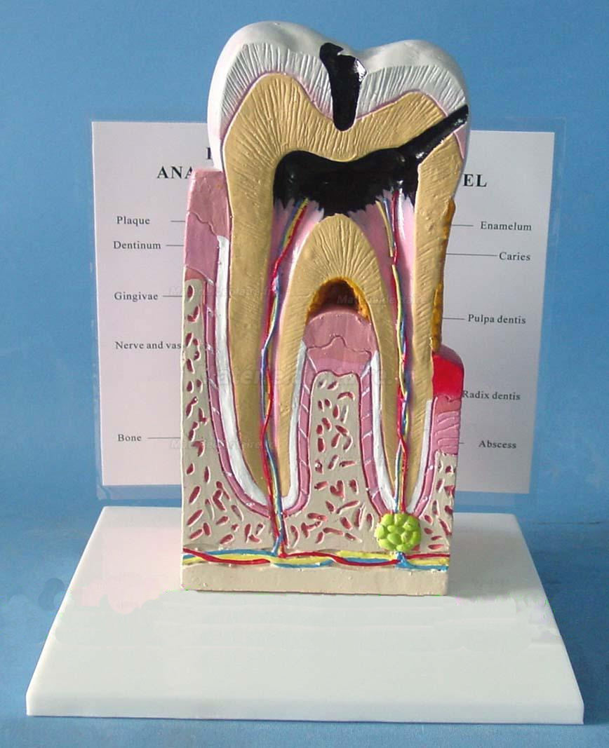 Modèle anatomique dentaire sectionné cavités dentaire Modèle agrandi