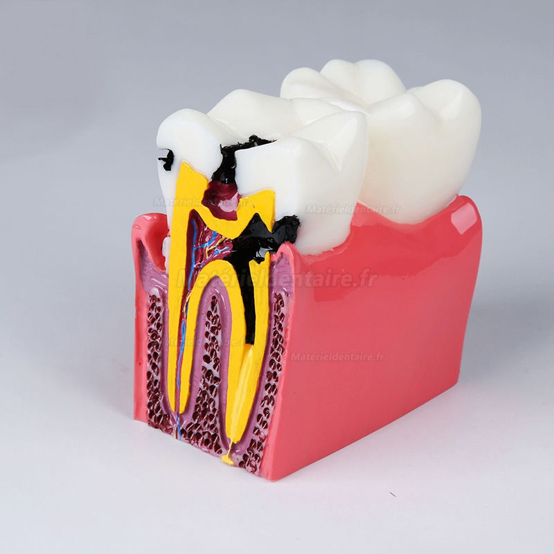 Modèle anatomique dentaire, comparaison des caries