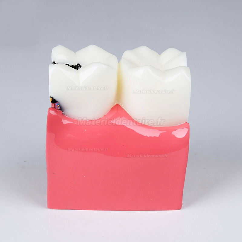 Modèle anatomique dentaire, comparaison des caries