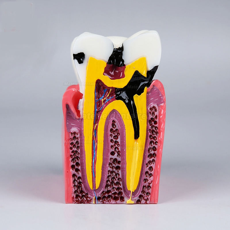 Modèle anatomique dentaire, comparaison des caries