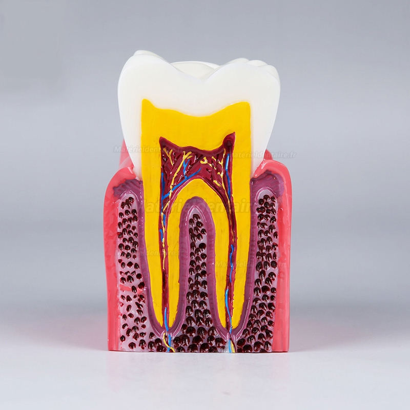 Modèle anatomique dentaire, comparaison des caries