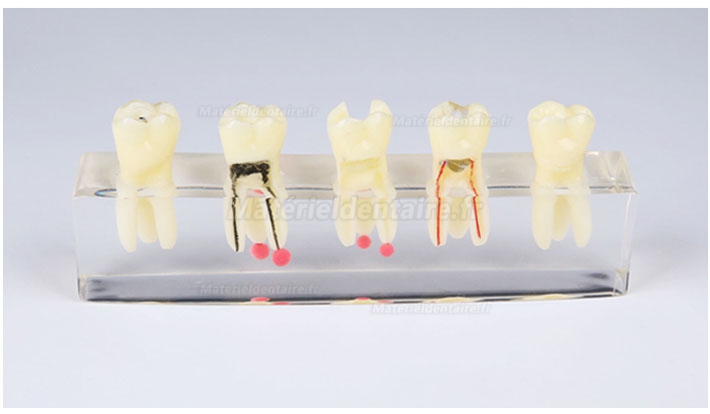 Modèle de pathologie canalaire