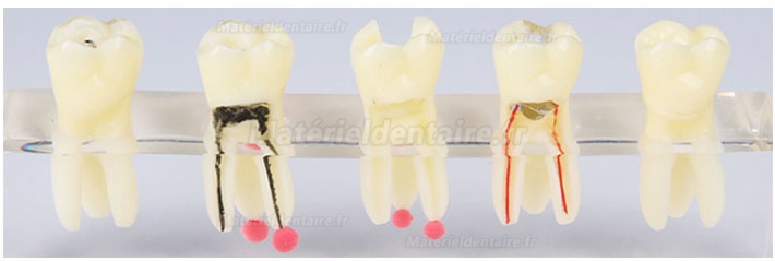 Modèle de pathologie canalaire