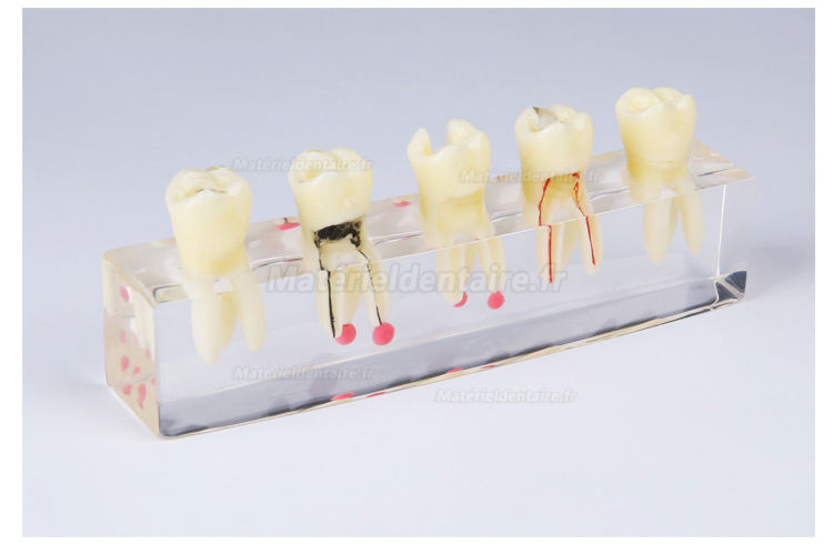 Modèle de pathologie canalaire