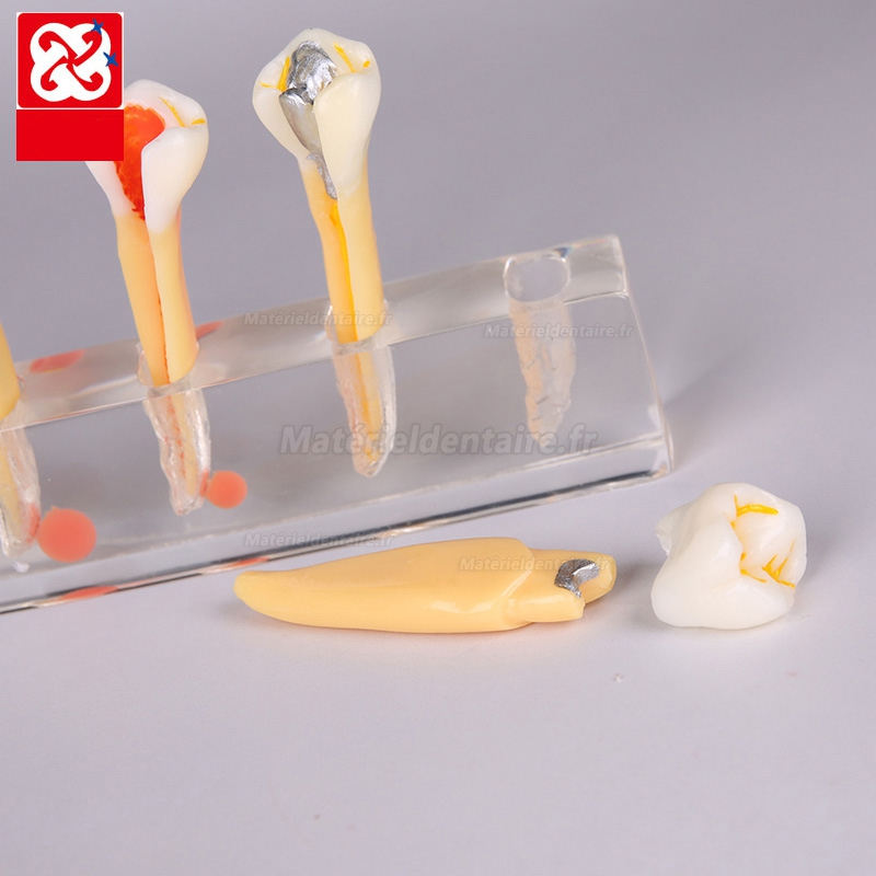 Modèle anatomique de carie dentaire