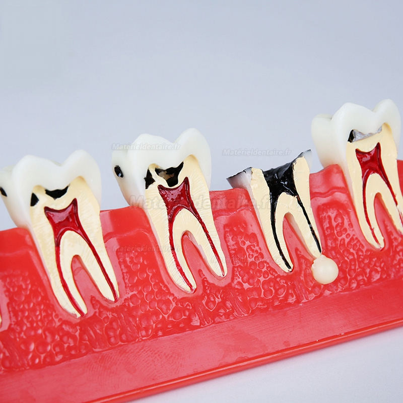 Modèle anatomique dentaires de classification des caries