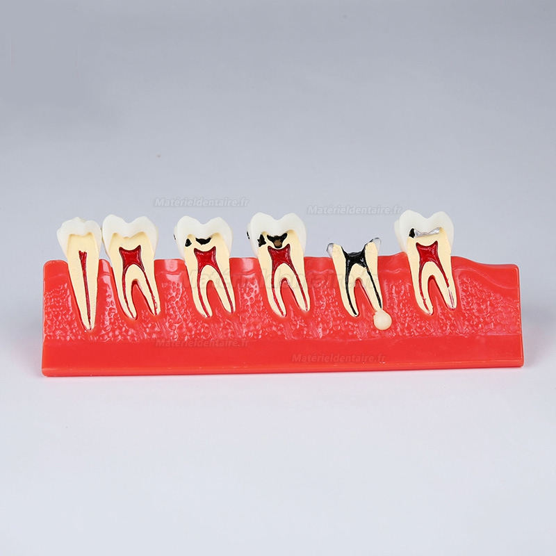 Modèle anatomique dentaires de classification des caries